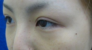 目の下のたるみ、目のくまでお悩みの方、切らずに完璧に解決します。TCB-R法　手術直後　症例写真